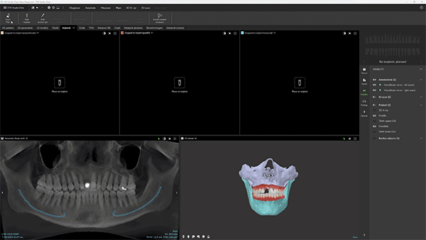 DTX Studio: Implant MagicAssist