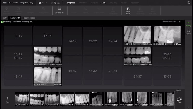 Full mouth detection with AI