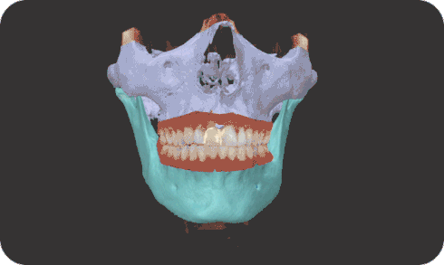 Skull Rotation: CBT + Intraoral scan 
