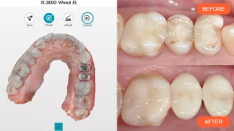 Clinical Case: Placement of Two Adjacent Crowns with a Highly Esthetic Outcome Using a Digital Workflow