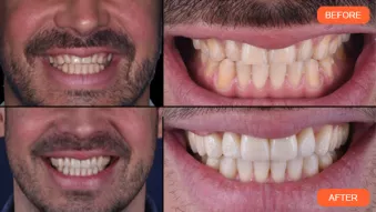 Clinical case by Dr. Carlo Massimo Saratti: final extraoral documentation - before-after results