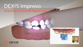 Imprevo - Acquiring Buccal Bite Registrations