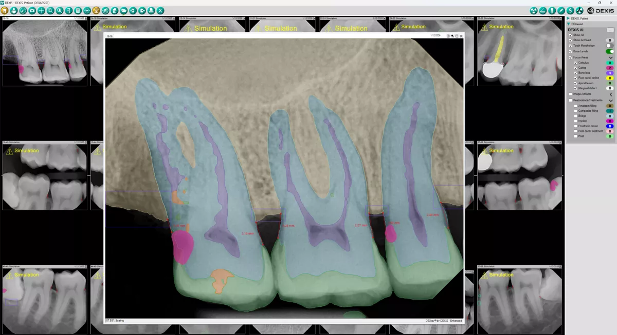 DEXassist Full Screen (No Caries Analysis)