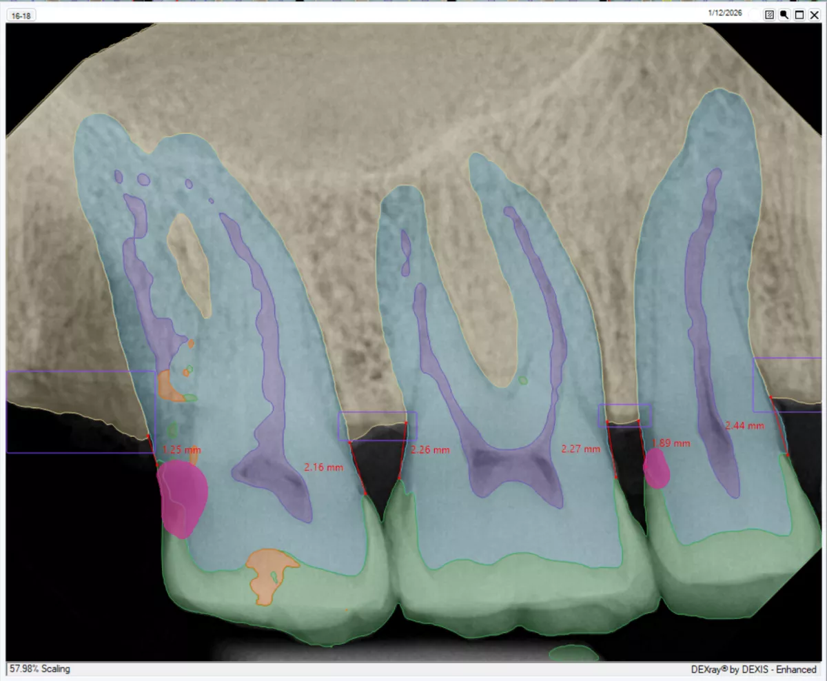 DEXassist Posterior PA