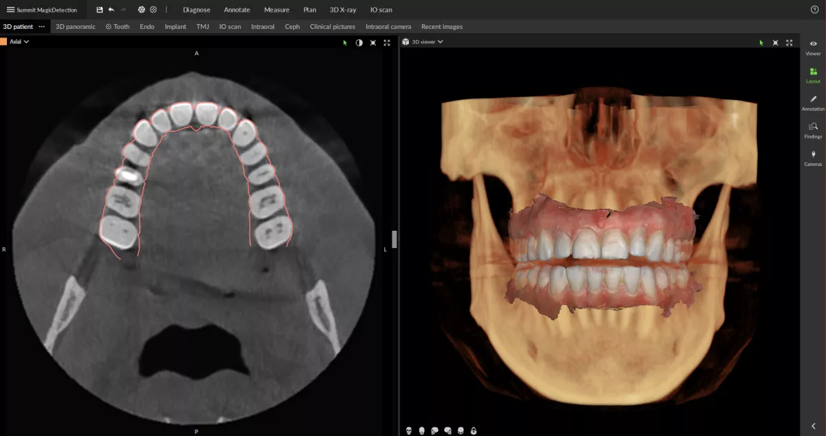 DTX Studio Clinic 3D and intraoral scan fusion