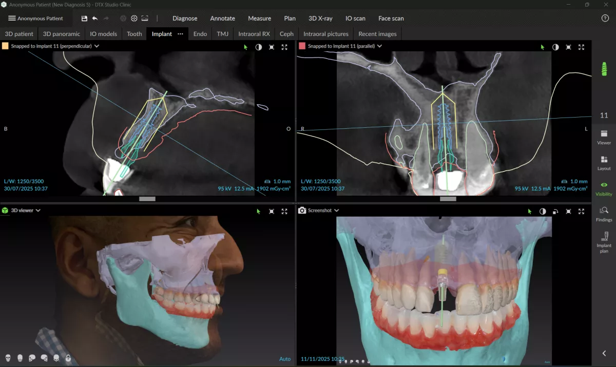 DTX Studio Clinic_4 7_Segmented adding face scan_Implant