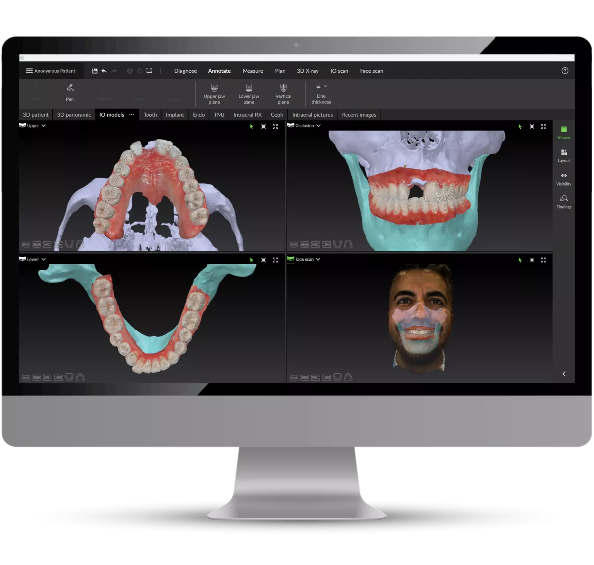 DTX implant case on monitor_blog