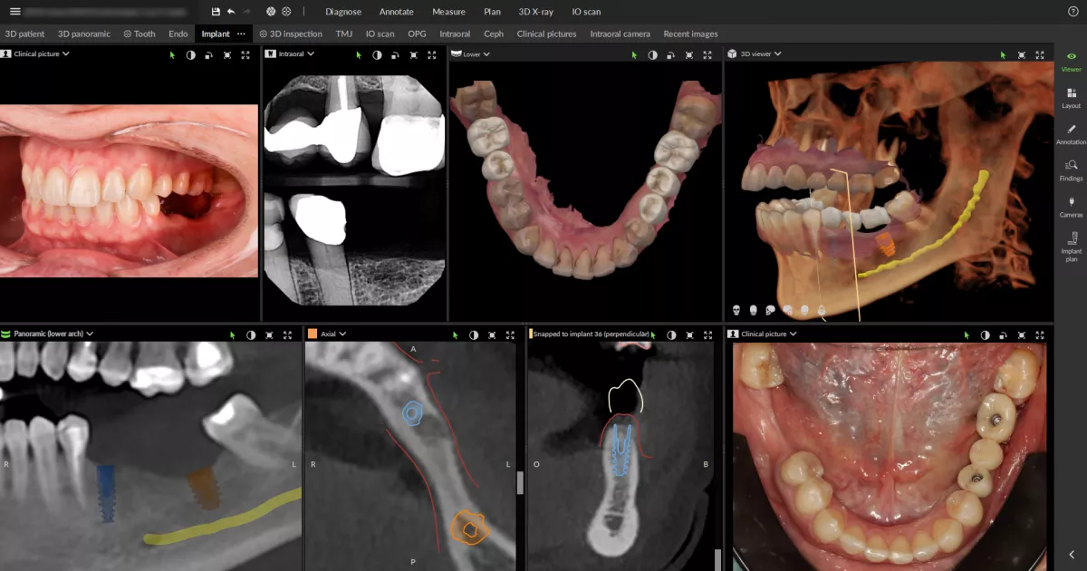 DTX+with+IOS+and+No+AI+Dental+findings