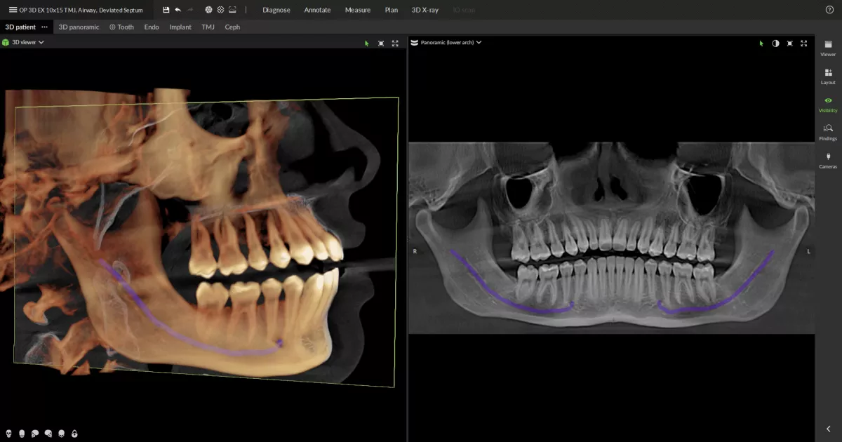 Automates-nerve-tracing,-pano-curve-and-TMJ-view-set-up1 DTX