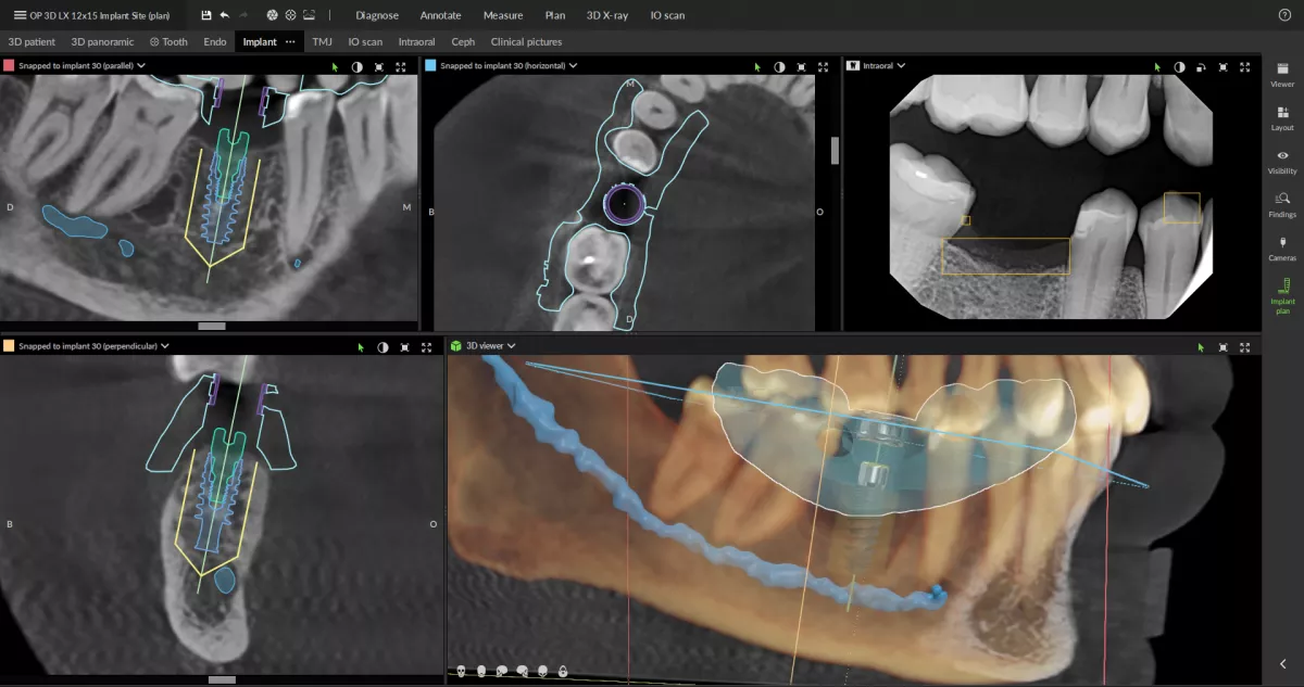 Enables users to generate surgical guides2_0 DTX