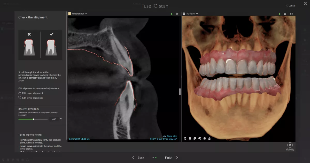 Identifies-tooth-numbers-on-IOS-and-AI-fuses-to-CBCT DTX