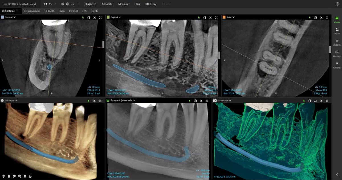 Uses-a-root-morphology-feature-to-examine-roots-for-endo DTX