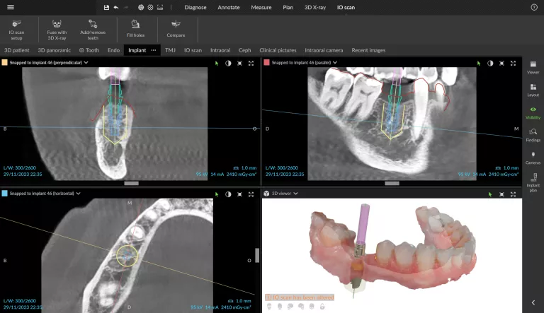 Abutment and implant planning