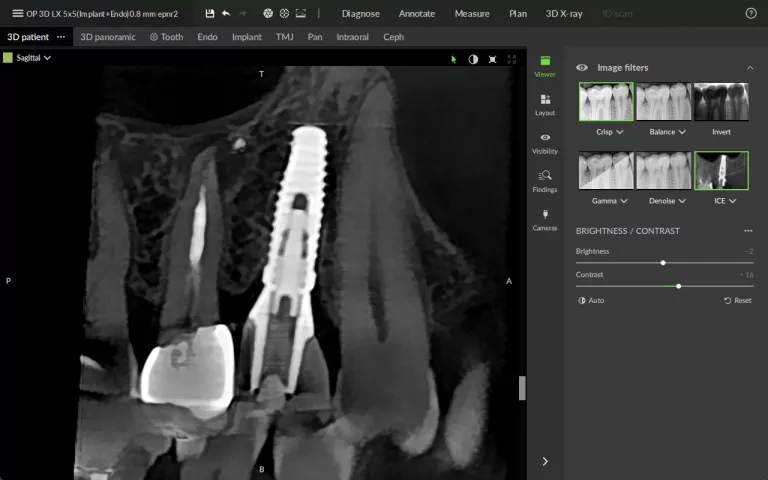 ICE (Implant Contrast Enahncer)