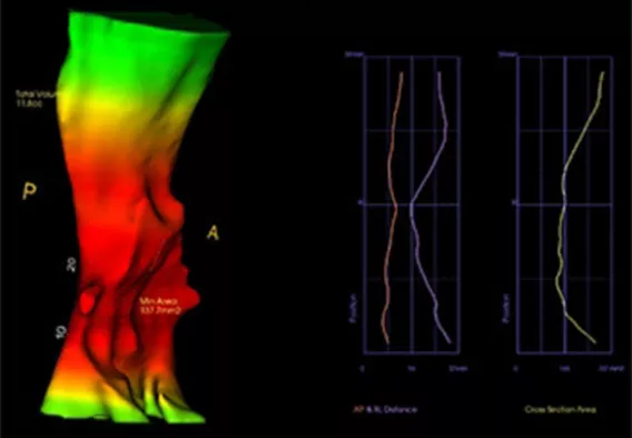 Airway Analysis
