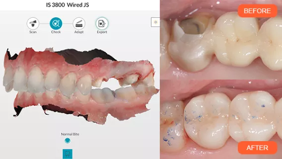 A 3-unit Bridge Restoration of a Fractured Ceramic Crown Using a Digital Workflow