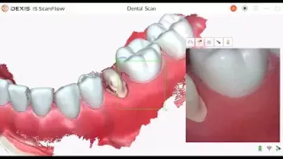 Intraoral scanning: proper scanning techniques