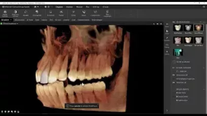 Featuring MagicAssist IOS AI to implant placement - DTX Studio Clinic