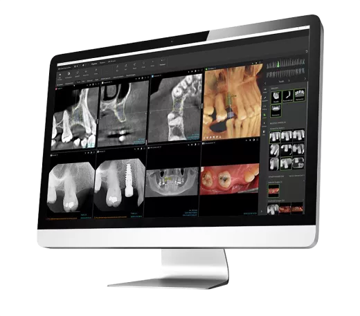 DEXIS IXS Imaging Implant DTX CBCT2