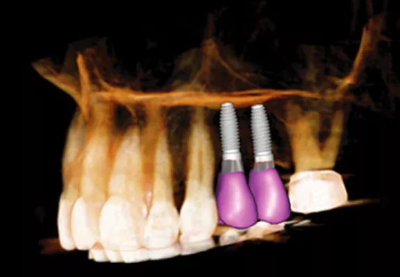 INVIVO implant