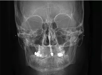 OP-3D X-ray PA head front