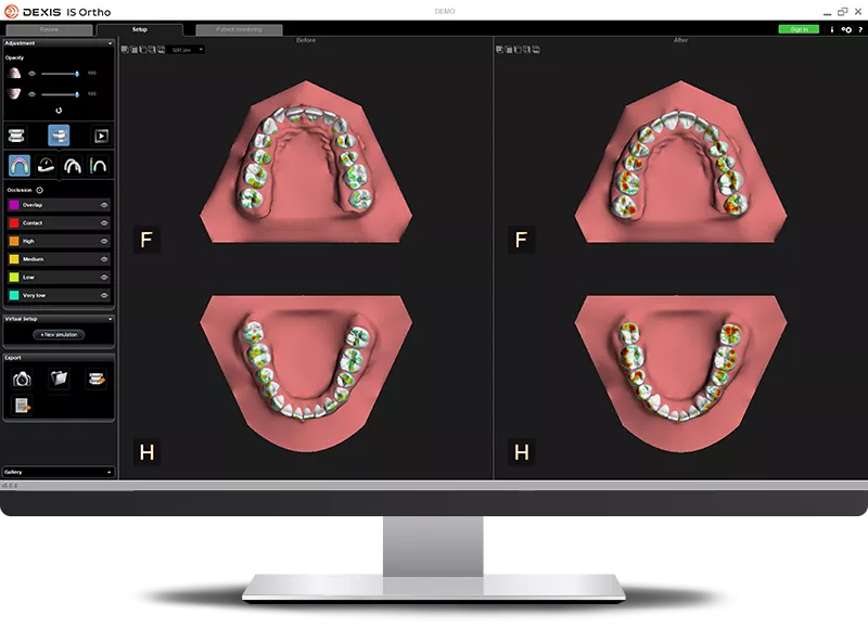 Simplify model analysis and setup with IS Ortho