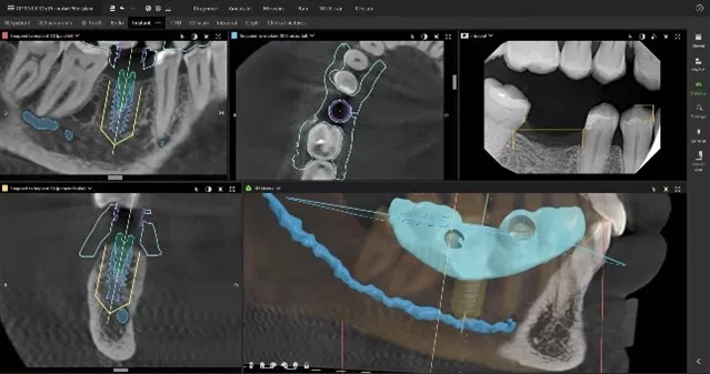 enables users to generate surgical guides