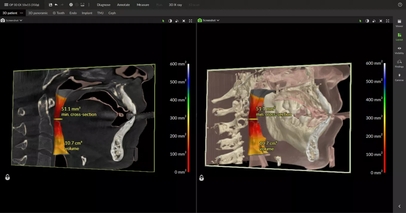 measures airway spaces and reports on these