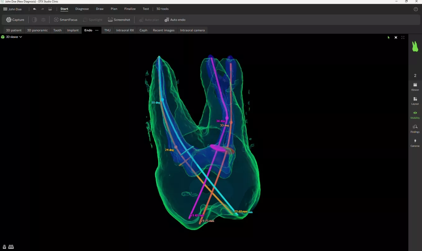 DTX 4.10_Endo_canal-segmentation