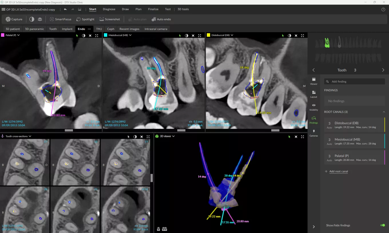 DTX 4.10_Endo_Cross-Sectional