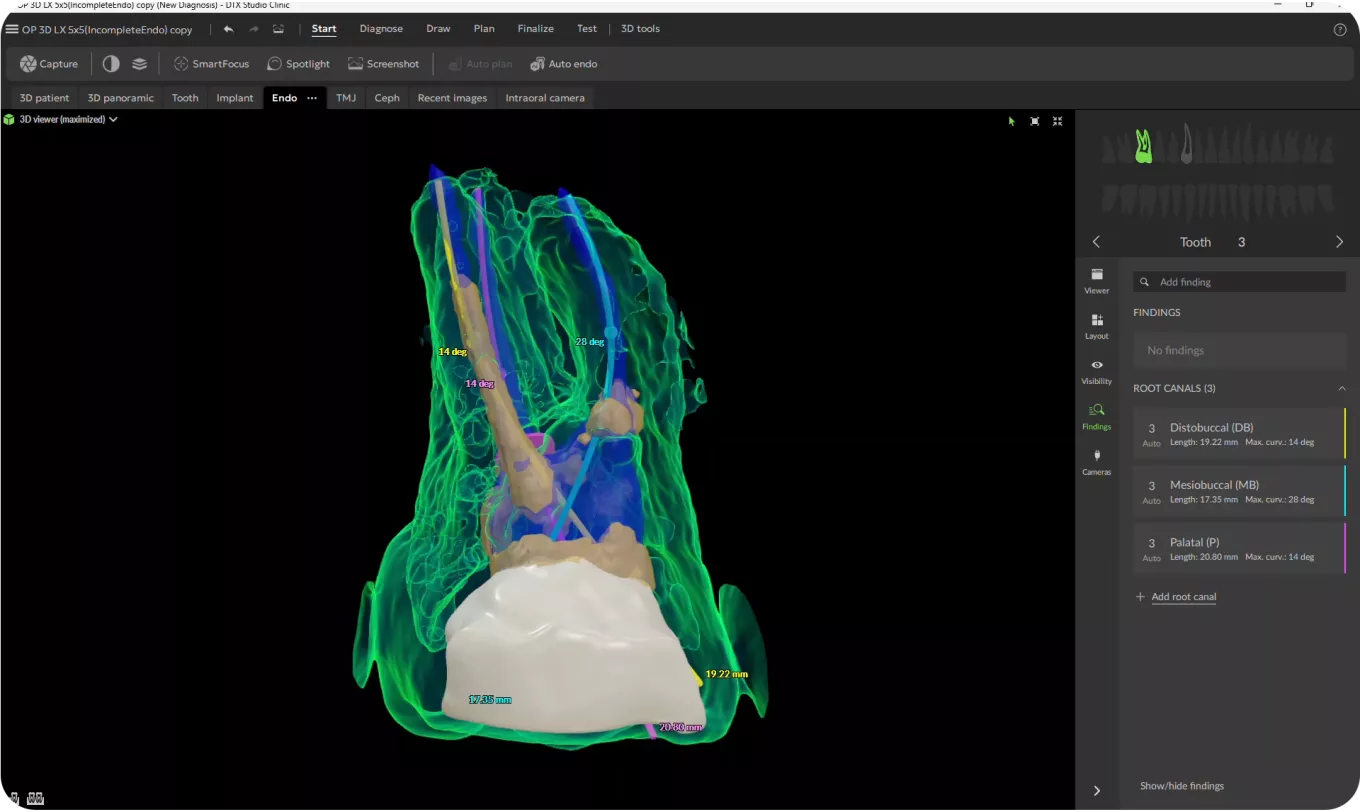root canal anatomy in 3D